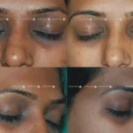 Dark Circle Treatments