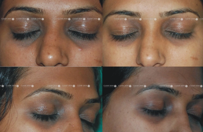 Dark Circle Treatments