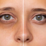 How Dark Circle Treatments Tackle Pigmentation Issues