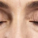 Can Dark Circle Treatments Fade Over Time Naturally