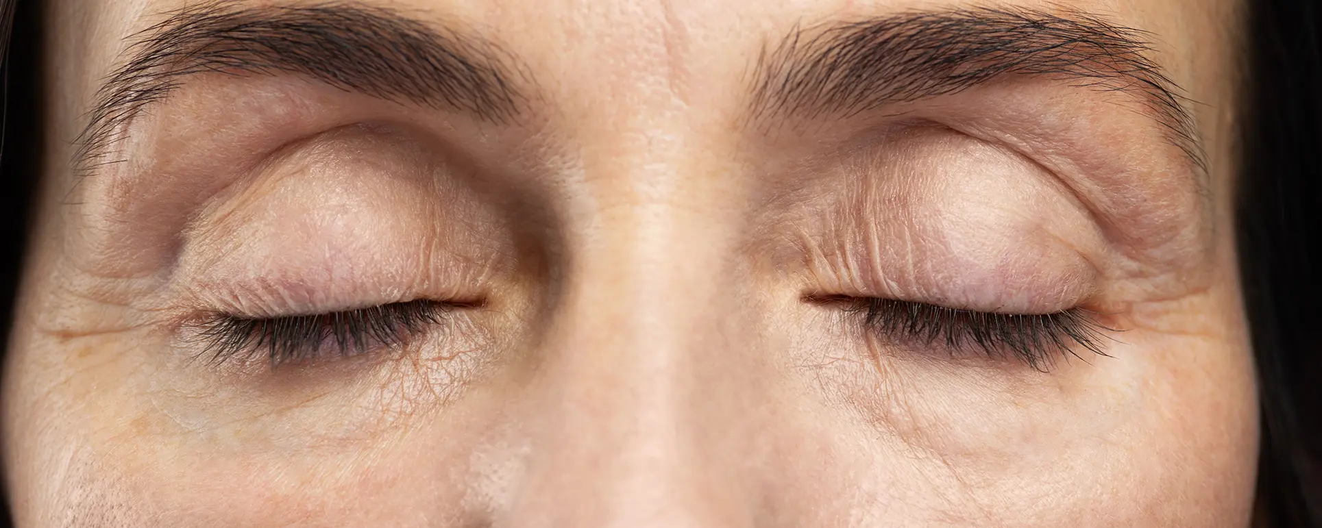 Can Dark Circle Treatments Fade Over Time Naturally