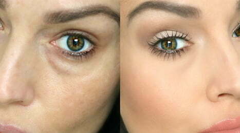 How Dark Circle Treatments Strengthen Under-Eye Texture