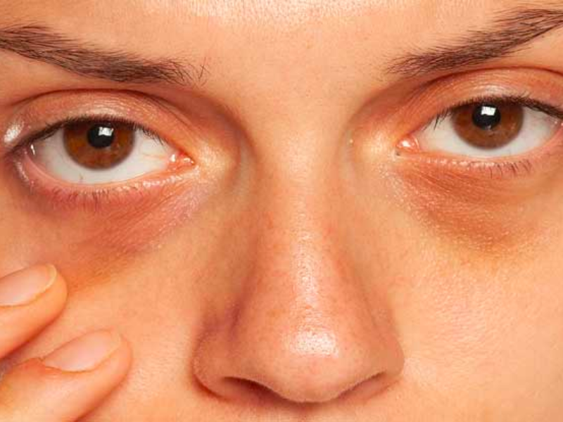 Do Dark Circle Treatments Prevent Future Discoloration