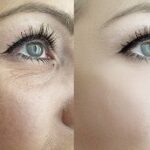 Where Dark Circle Treatments Provide Best Coverage