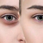 What Dark Circle Treatments Offer For Sensitive Skin