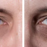 Do Dark Circle Treatments Improve Skin Brightness