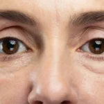 Can Dark Circle Treatments Reduce Puffiness Too